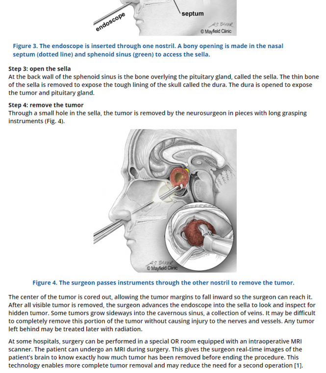 Од кај им е идејата: Едноскопска трансфеноидална операција за отстранување на тумор од хипофиза